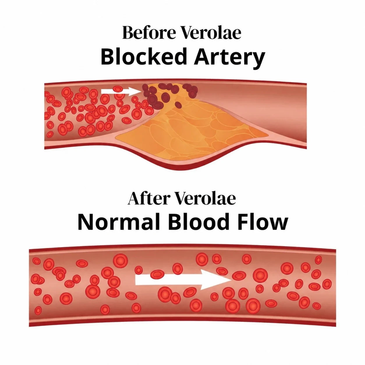 Diagram comparing a cholesterol-blocked artery with one restored to normal blood flow